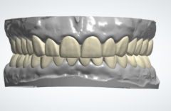 Full Mouth Rehabilitation