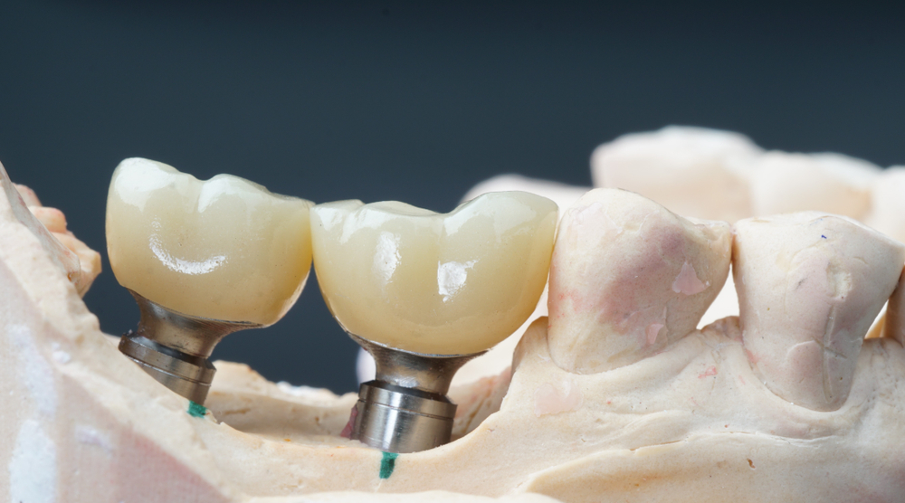 Custom Abutments