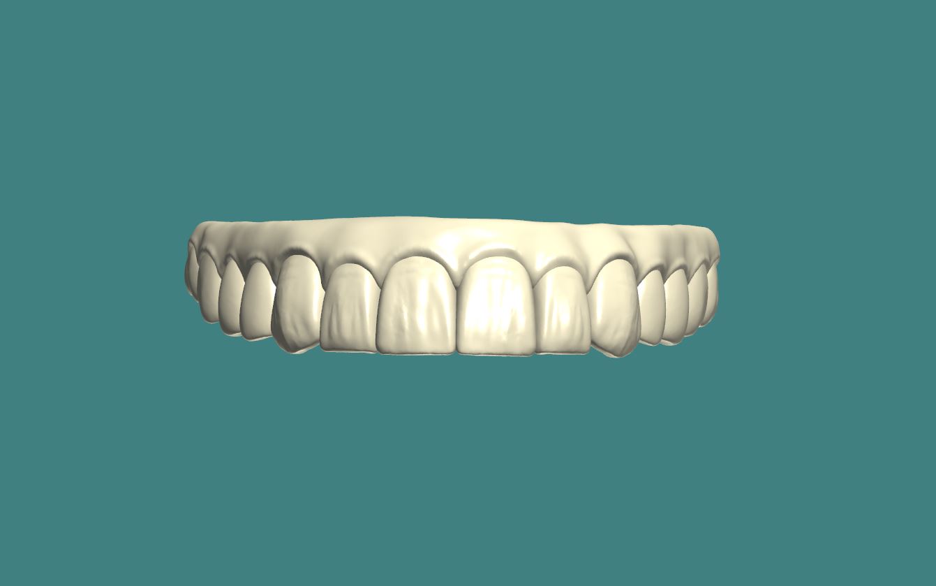 Hybrid Denture
