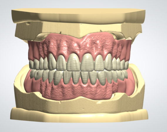 Full Denture